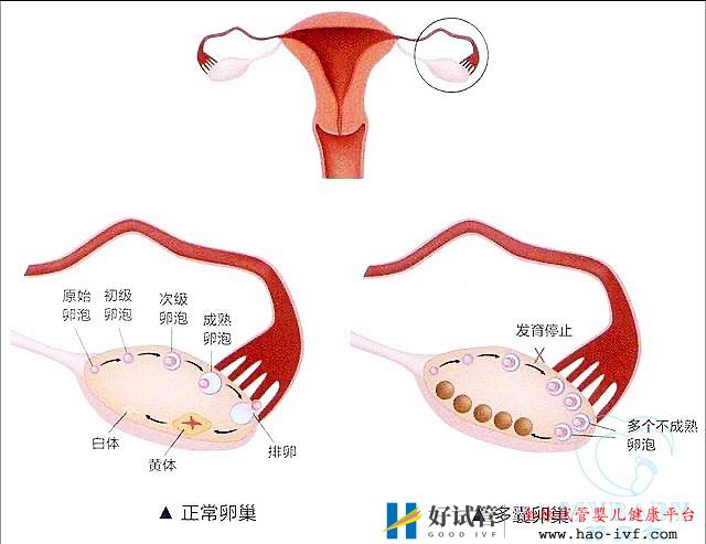 多囊卵巢综合症能做试管婴儿吗？成功率多少(图1)