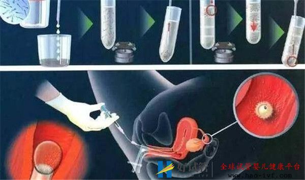 试管婴儿移植成功率和移植的胚胎多少有关系么移植后需要注意哪些(图1)