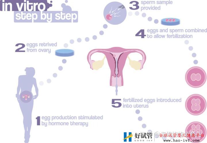 试管婴儿1代、2代、3代、4代哪个最好真实操作过...(图4)