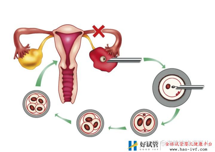 试管婴儿1代、2代、3代、4代哪个最好真实操作过...(图8)