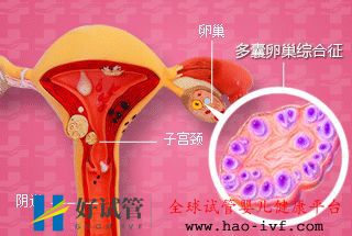 多囊想做试管这几个问题看完心里有谱了!(图4)