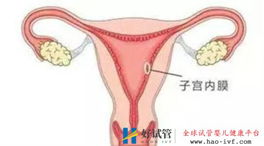 做俄罗斯试管婴儿需要调理内膜吗？调内膜一般要多少天(图1)