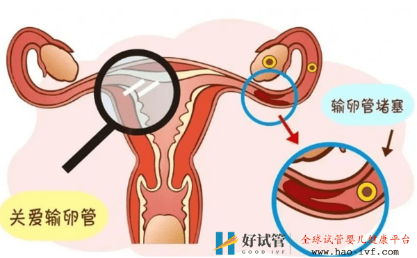 试管婴儿有哪些适应症(图1)