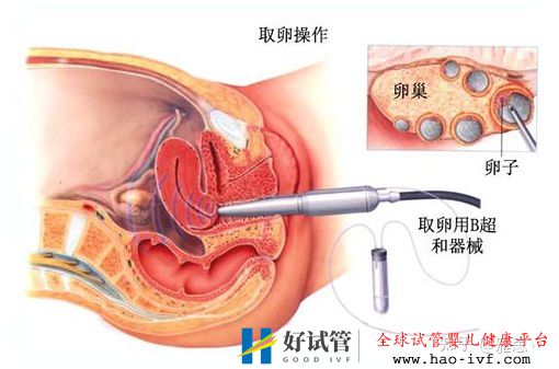 女人做试管过程痛苦吗(图3)