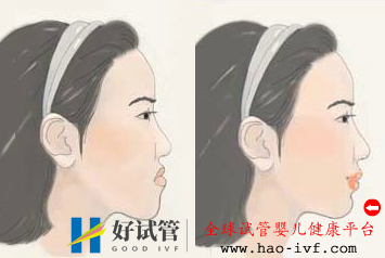 儿童地包天矫正需要多长时间(图1) 儿童地包天矫正需要多长时间(图1)