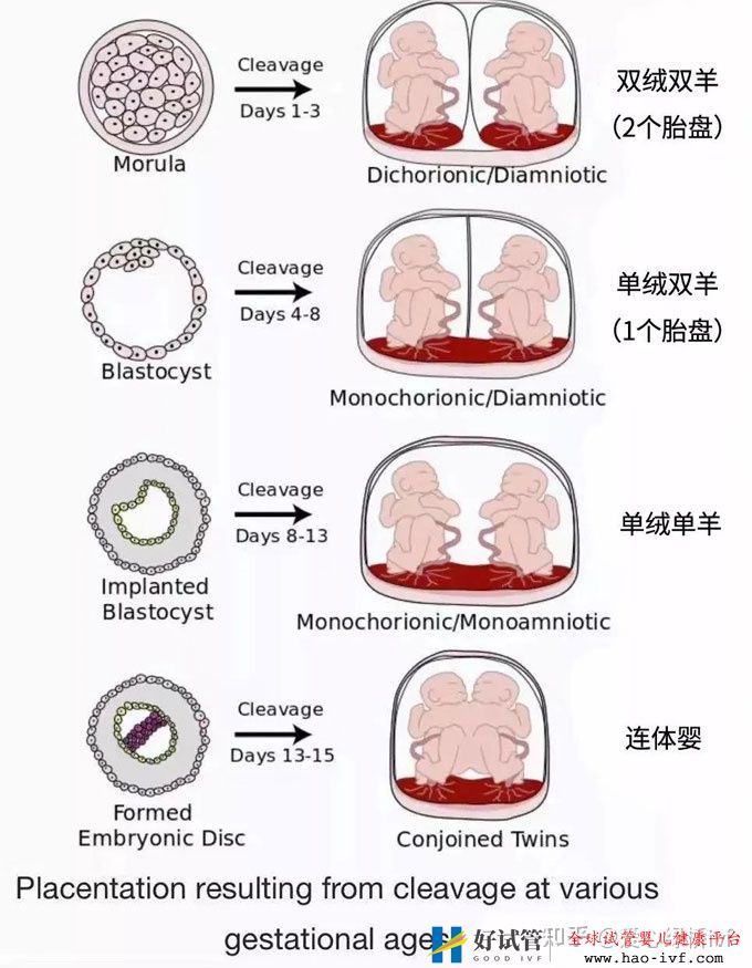 试管双胞胎是单绒还是双绒(图1)