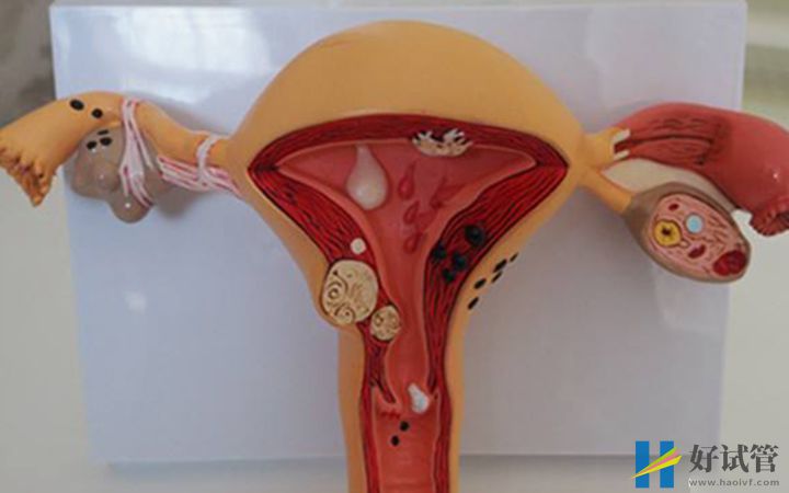 子宫内膜异位症是引起排卵障碍的原因之一