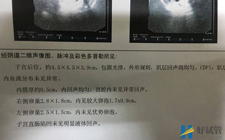 卵泡破裂报告单