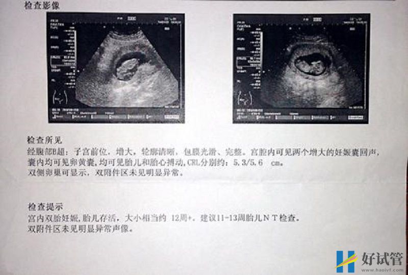 怀双胞胎的B超单