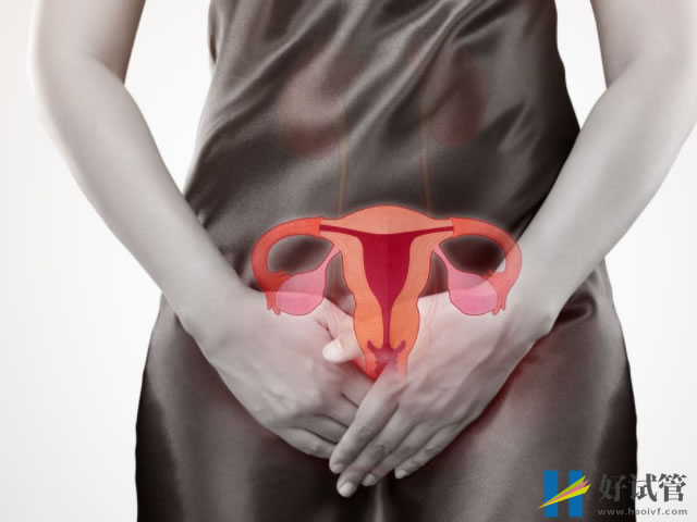 子宫内膜异位症的有四种类型