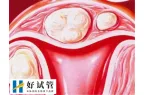 宫颈息肉试管老是生化怎么办