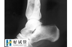 试管婴儿后发现骨肉瘤怎么办