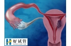 多囊做试管婴儿前怎么调理