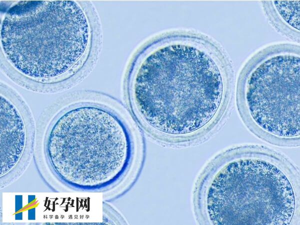 黄体期促排方案适合哪些人群(图1) 多囊卵巢适合黄体期促排卵方案